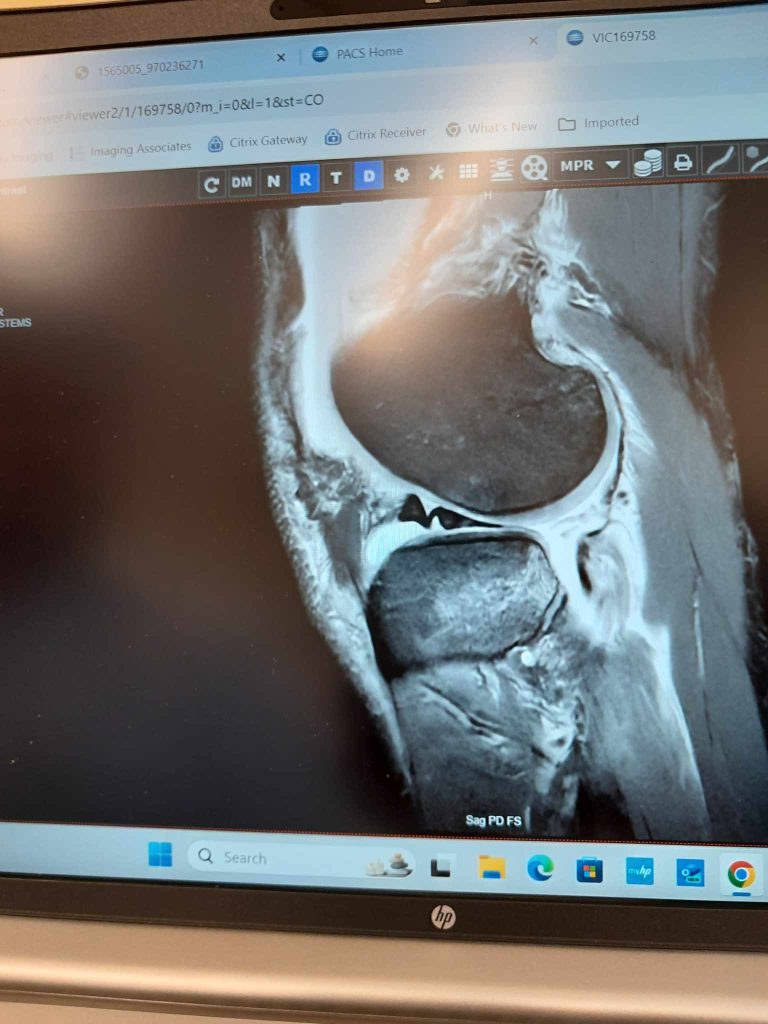 Bilder på mitt knä från magnetröntgen.